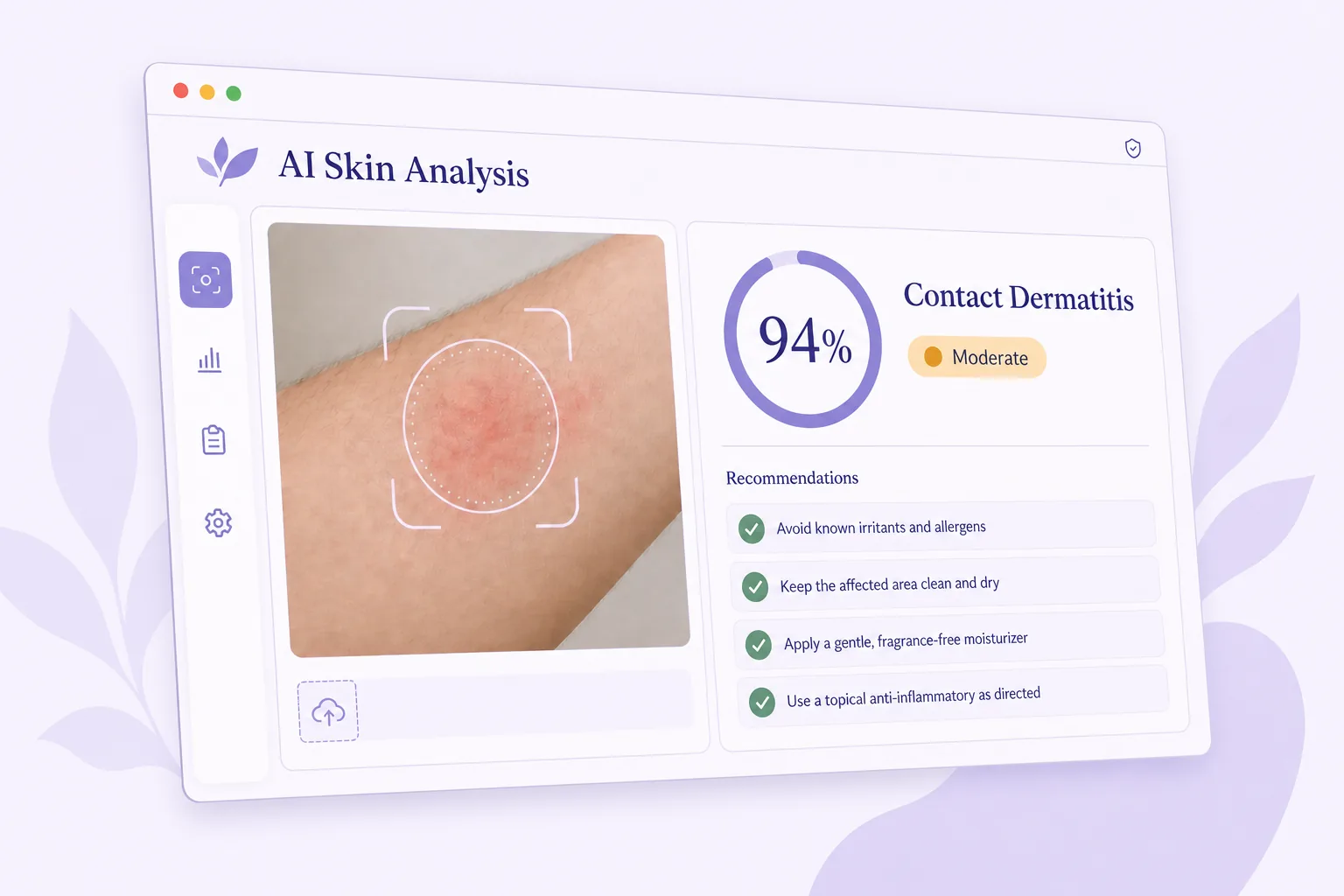 RashScan online skin checker showing an instant scan result with condition name and severity level