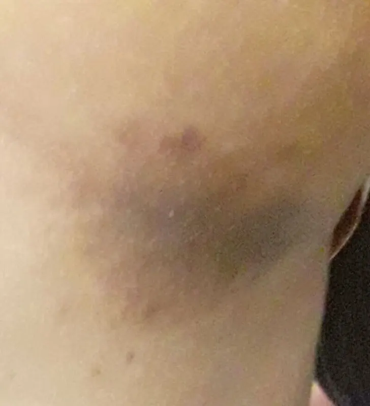 Erythrasma: a flat brownish-red patch in a skin fold