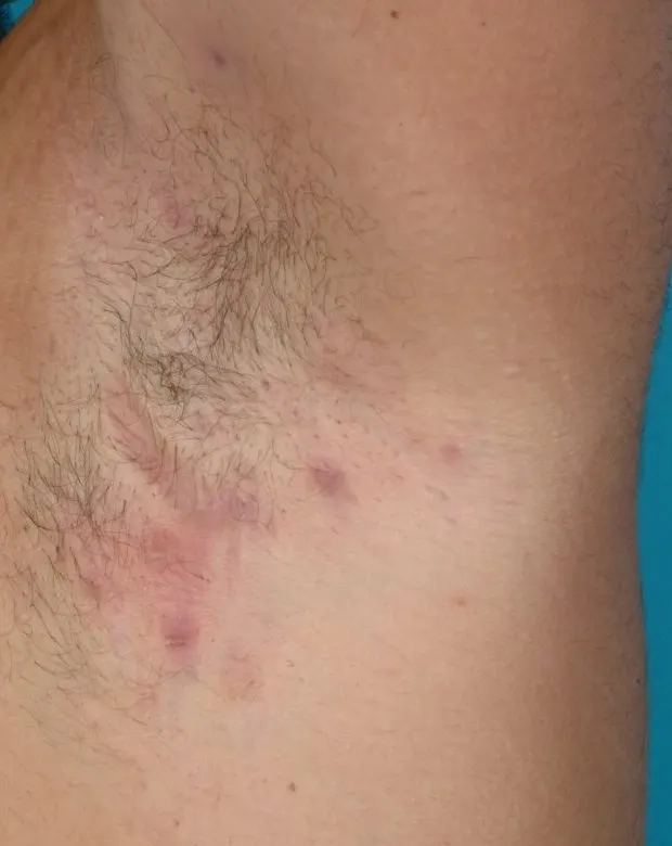Hidradenitis suppurativa in the armpit: several red-purple lumps and small scars