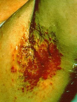 Infected intertrigo in the armpit: raw, red, moist skin deep in the fold