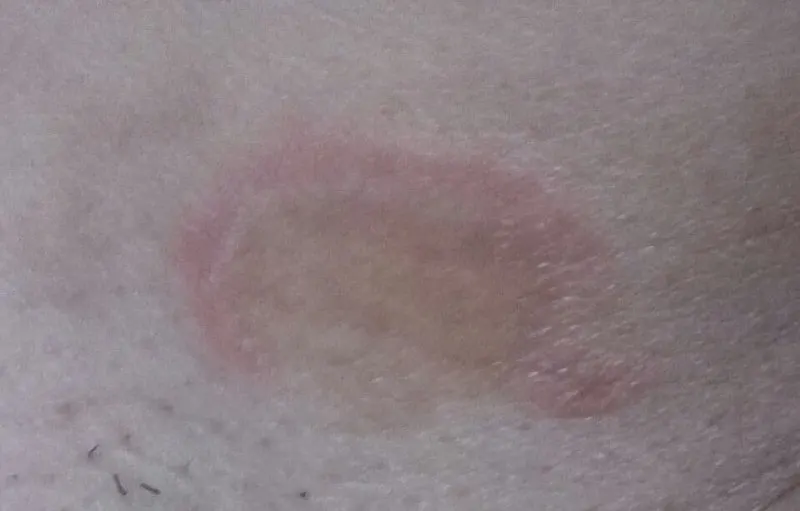 Ringworm in the armpit area: a round pink patch with a raised red border and a clearer center