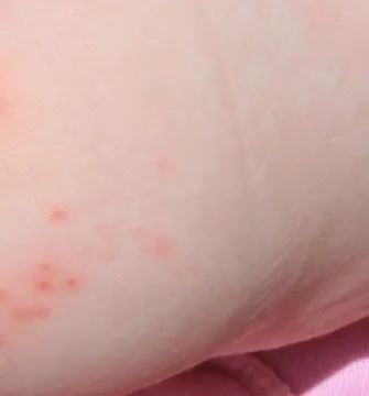 Small scattered red spots on a baby's buttock