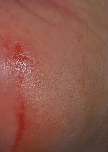 Mild irritant diaper rash: red patches and streaks on a baby's buttock