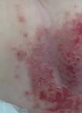 Yeast diaper rash: beefy-red patch with small red satellite spots beyond its edge